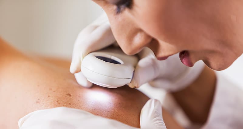 The 3 Major Types of Skin Cancer