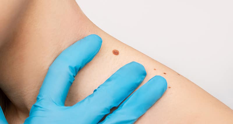 provider checking mole on an arm