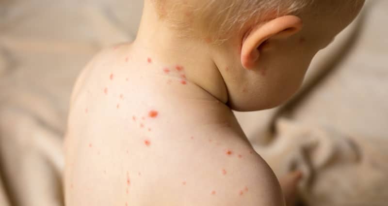 child with small red spots