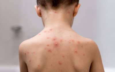 Chickenpox: What You Need to Know