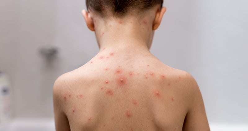 child with chicken pox