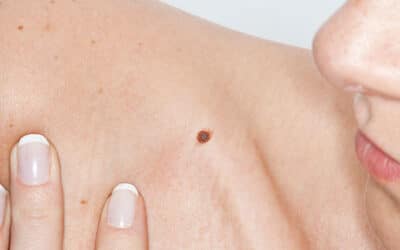 Moles: When Should I Worry?