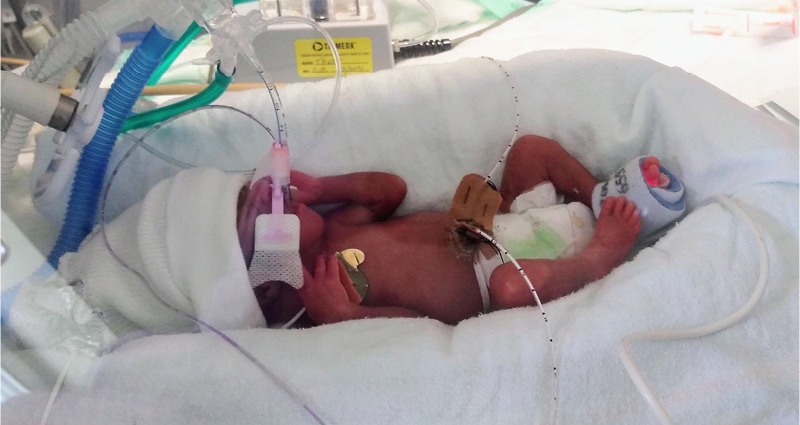 A very small premature baby is hooked up to tubes and monitors. The infant is wearing a fuzzy white hat.